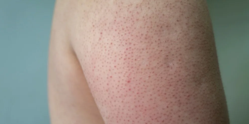 Keratosis Pilaris - treating chicken skin on arms