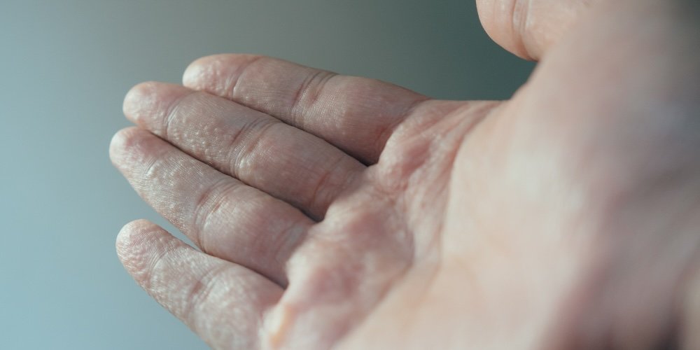 pompholyx eczema - ezcema on hands and feet