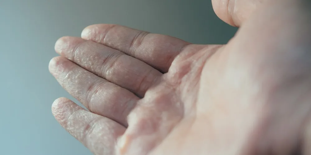 pompholyx eczema - ezcema on hands and feet