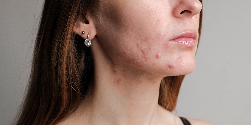 cystic pimples - acne treatment from a dermatologist