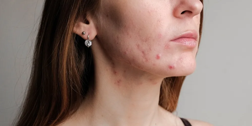 cystic pimples - acne treatment from a dermatologist