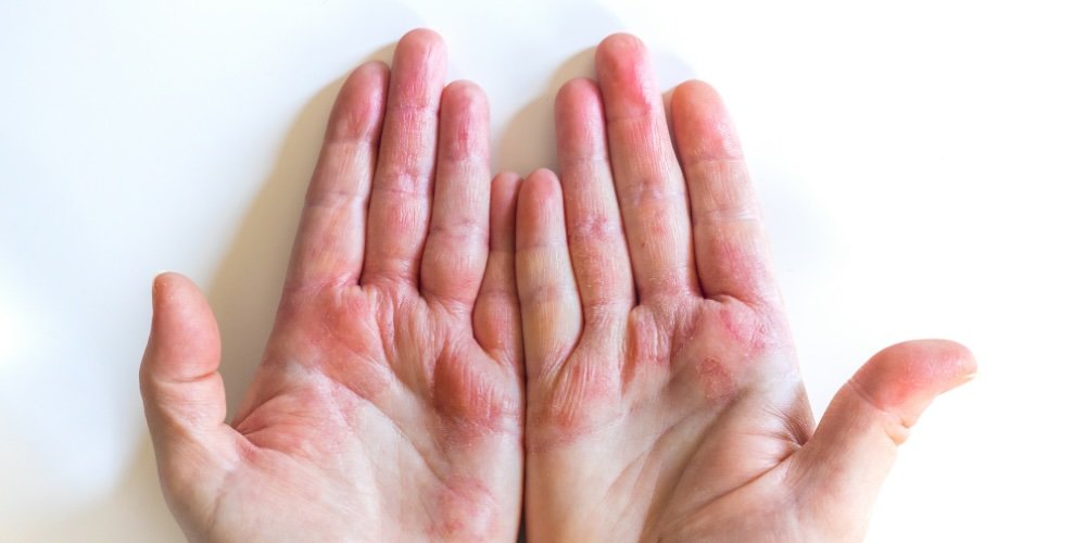 eczema on hands - a dermatologist explains pompholyx eczema.