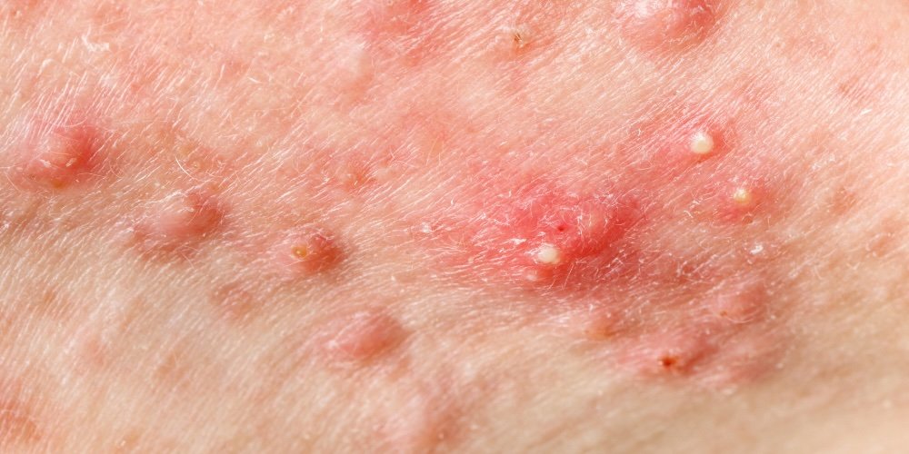 how to get rid of whiteheads - a dermatology guide