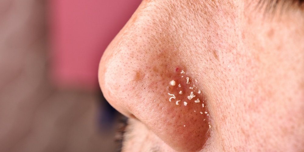 sebaceous filaments on the nose