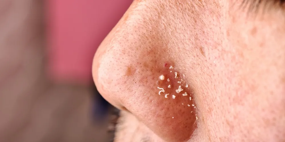 sebaceous filaments on the nose