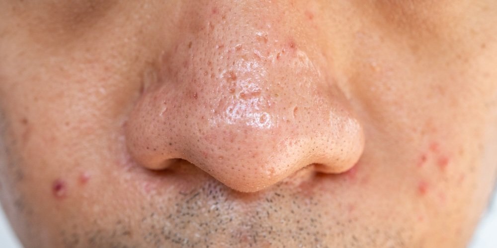 sebaceous filaments vs blackheads on nose