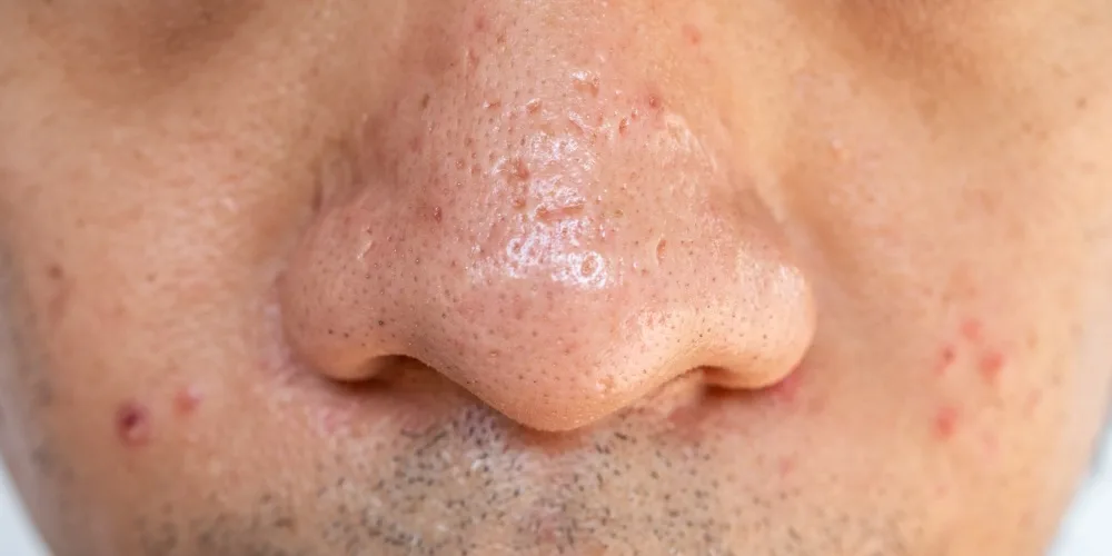 sebaceous filaments vs blackheads on nose