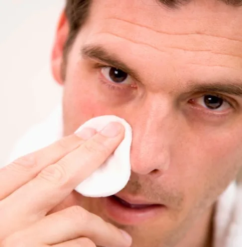 treatment for sebaceous filaments