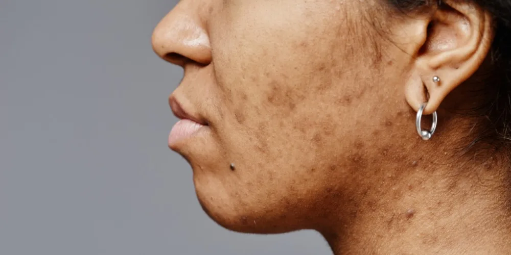 hyperpigmentation on dark skin tone