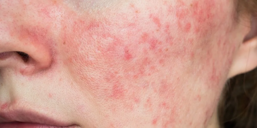 rosacea treatments - what works best