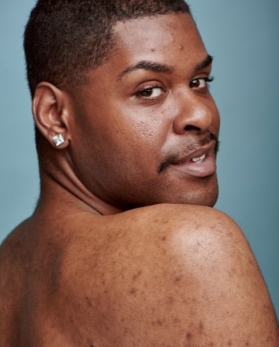 skin conditions in dark skin
