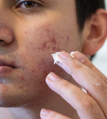 whitehead treatment from a dermatologist