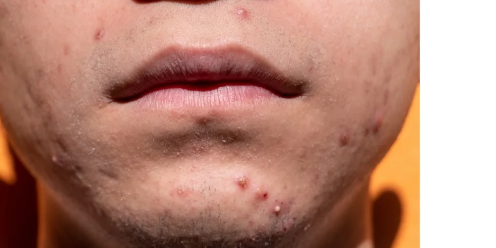 how to prevent whiteheads from coming back - dermatologist guide