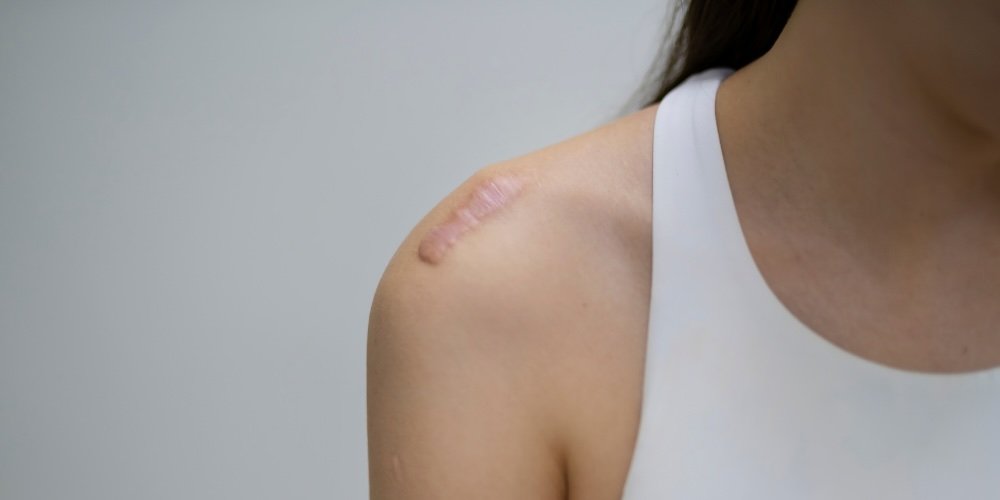 keloid scar treatment london