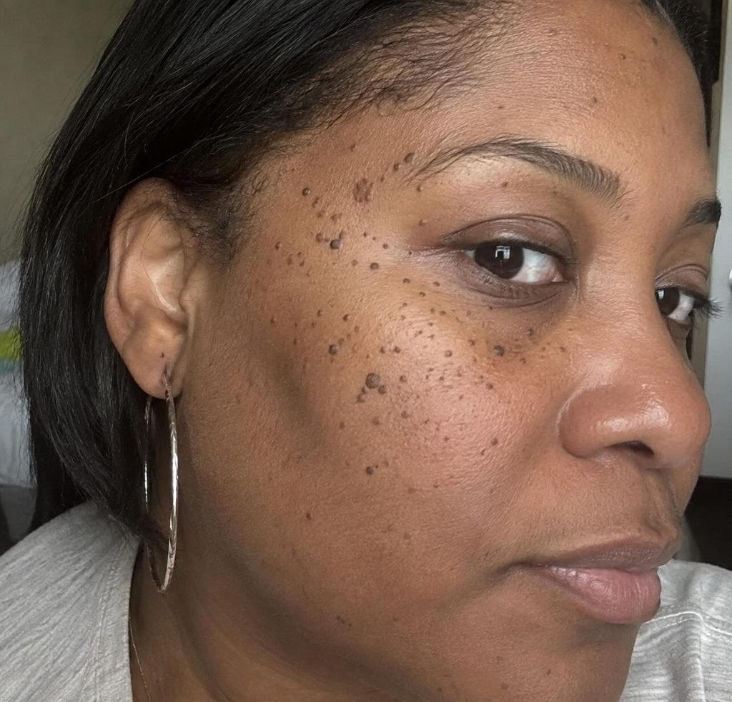 dermatosis papulosa nigra - common skin lesions