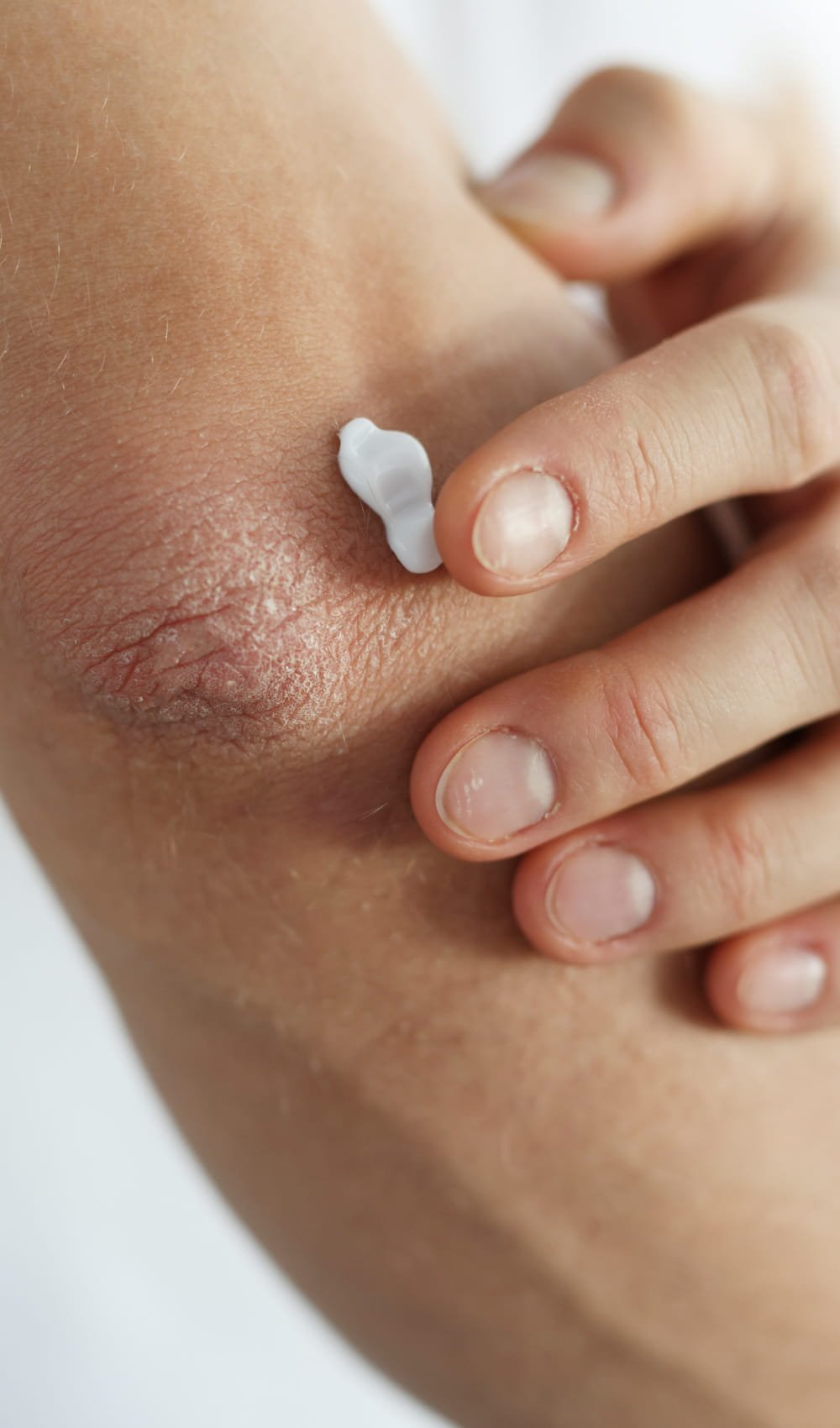 card eczema
