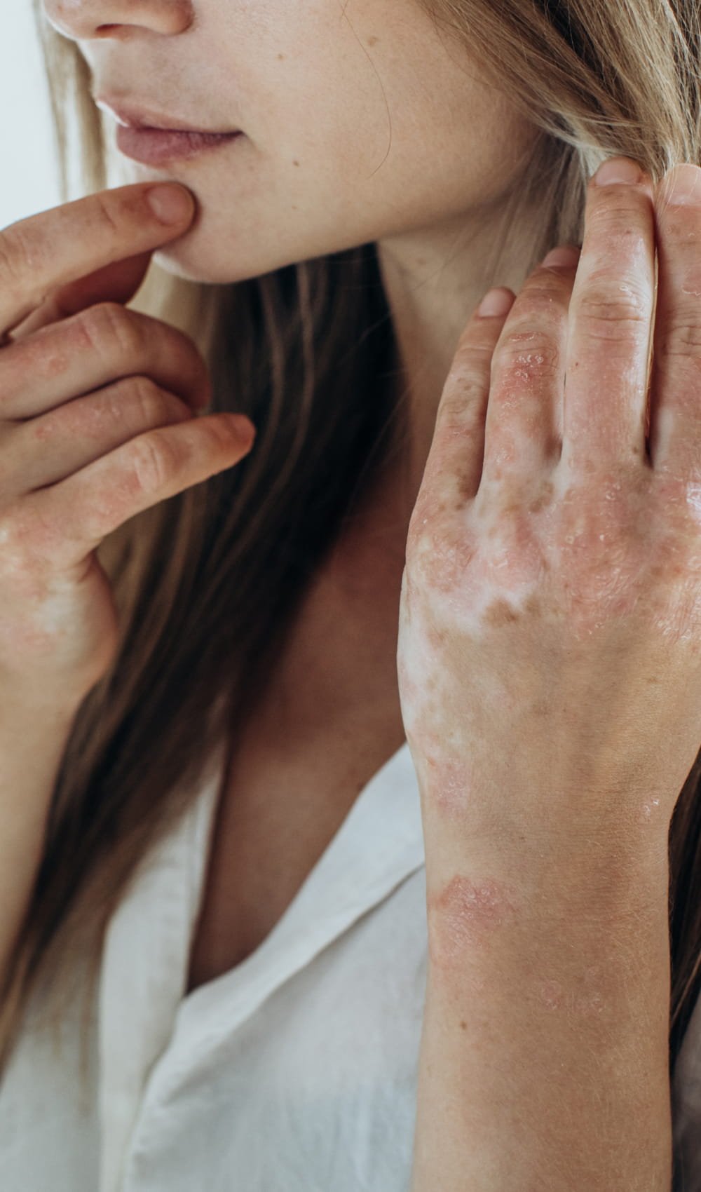 card psoriasis