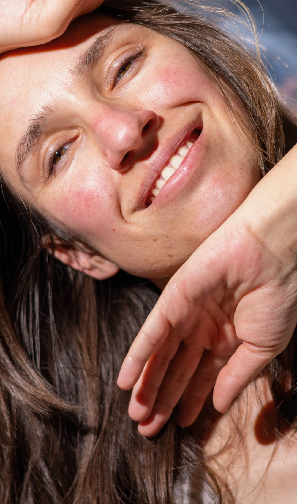 card rosacea