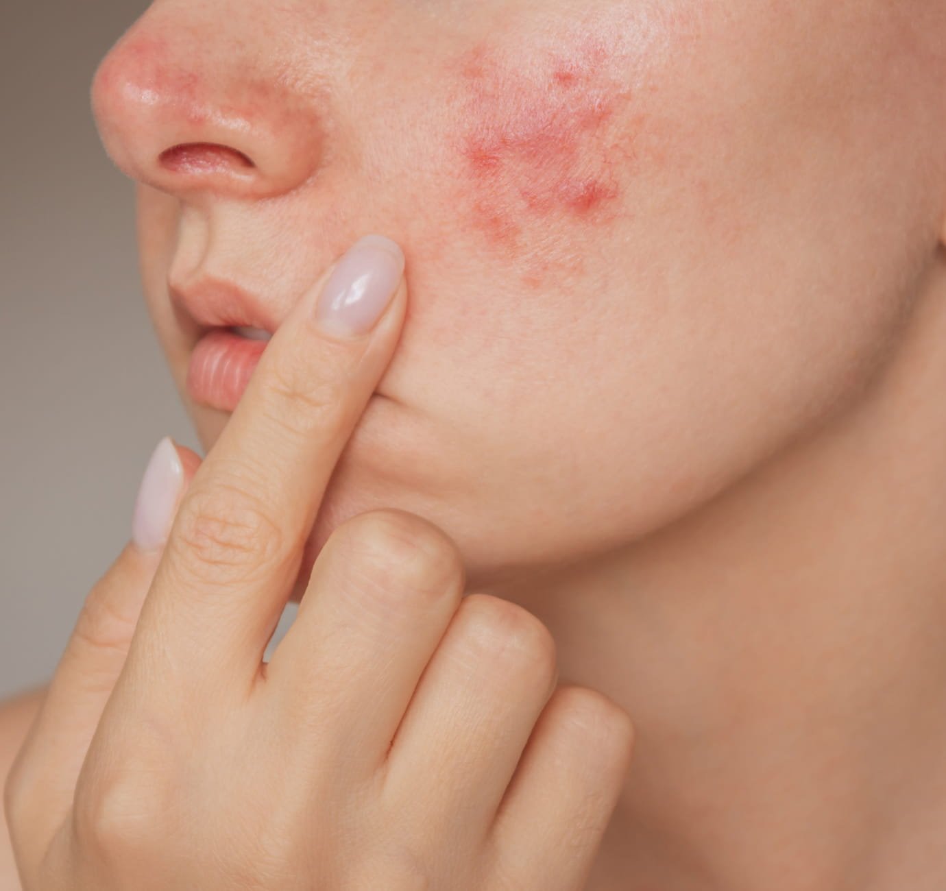 eczema on face