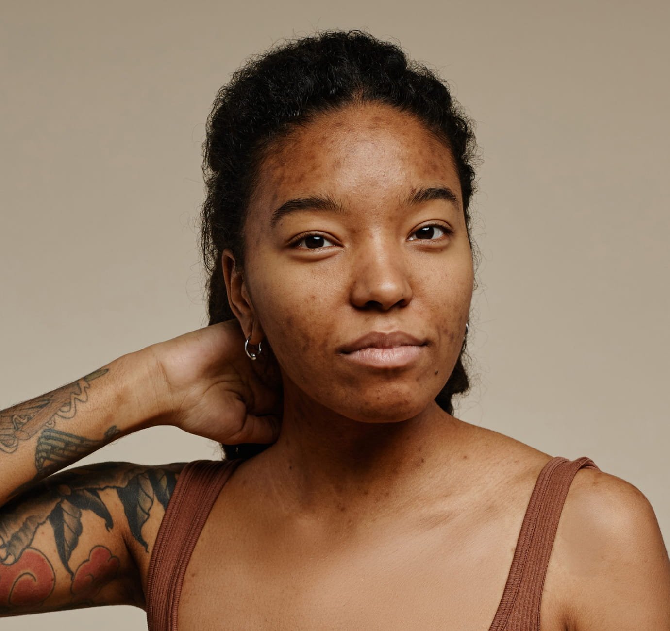A portrait of African American woman with acne