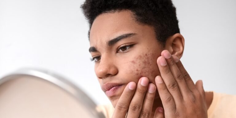 types of acne