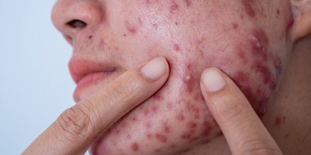 types of acne guide